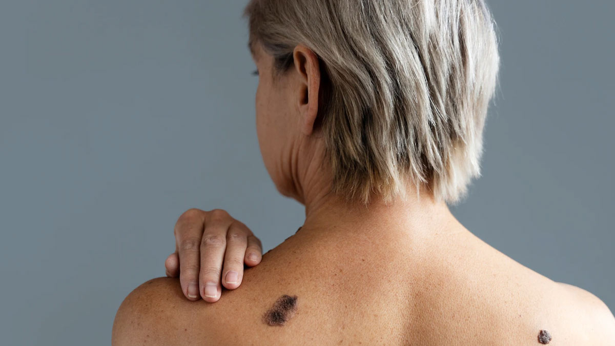 Nếu được phát hiện sớm, tỷ lệ sống sót sau 5 năm của melanoma là hơn 99 phần trăm