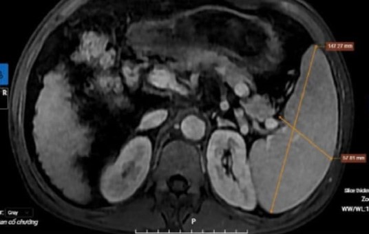 Kết quả chụp MRI của bệnh nhân cho thấy hình ảnh xơ gan lách to, dịch bao quanh gan