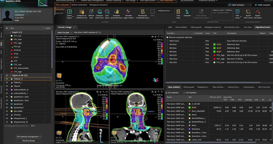 AI mô phỏng lập kế hoạch xạ trị cho một ca ung thư