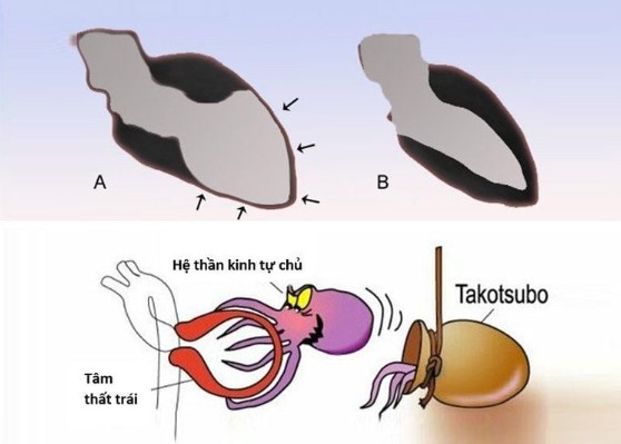 Một lượng lớn hormone căng thẳng như adrenaline có thể làm giãn cơ tim