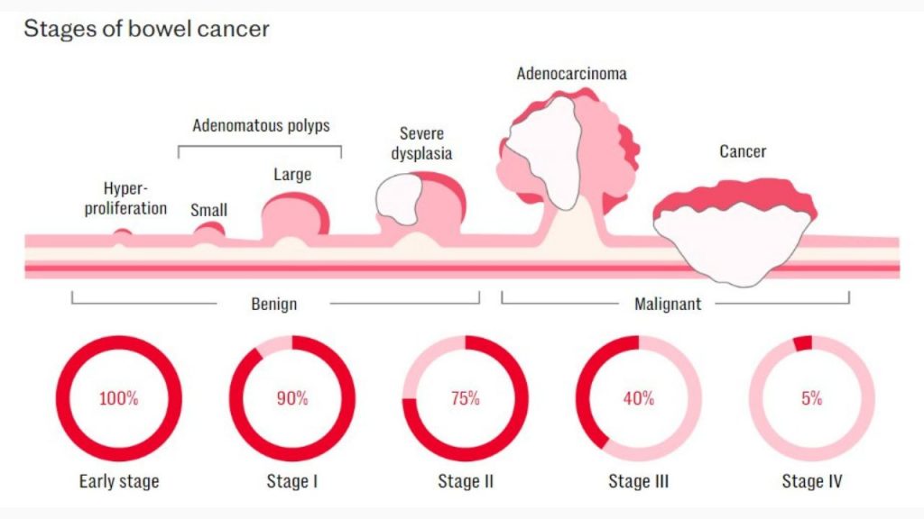 Các giai đoạn của ung thử ruột