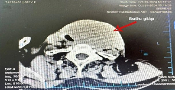 Hình chụp CT bướu tuyến giáp của bệnh nhân L.T.T.NẢNH: BỆNH VIỆN BÌNH ĐỊNH