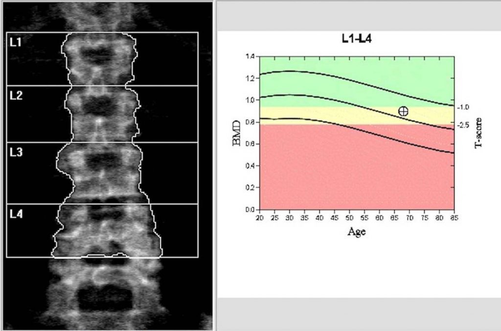 Dùng levothyroxine liên quan đến mất tổng khối lượng xương và mật độ xương nhiều hơn