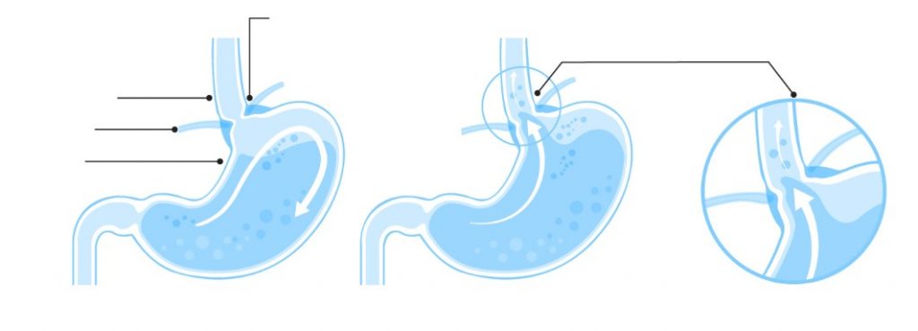 Bệnh trào ngược dạ dày thực quản (GERD) gây ra chứng trào ngược axit như thế nào?