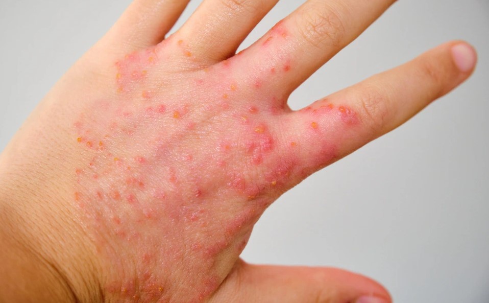 Những triệu chứng này có thể do viêm da (dermatitis) hoặc vảy nến (psoriasis) gây ra