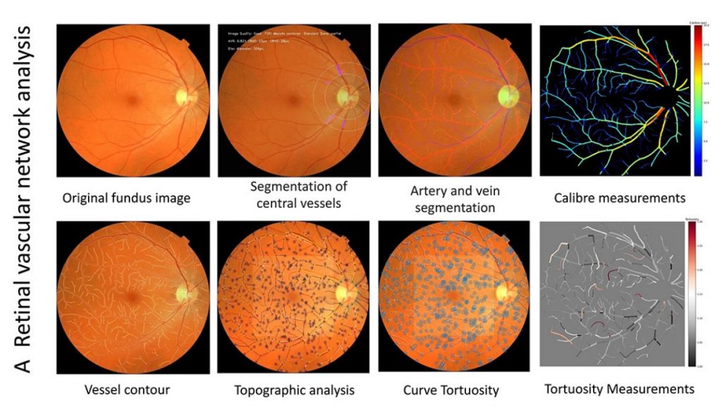 Ảnh chụp đáy mắt sử dụng AI để phát hiện các đặc điểm khác nhau của mạch máu