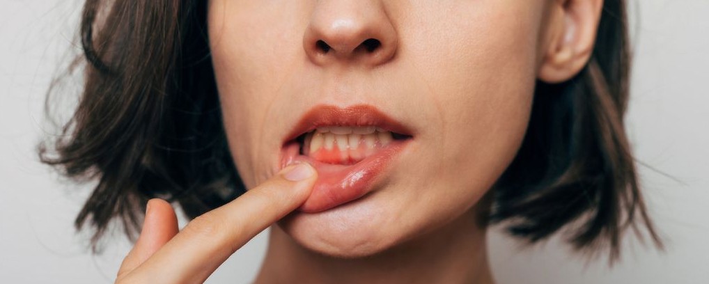 Chăm sóc răng miệng kém có thể âm thầm gây hại cho... trái tim